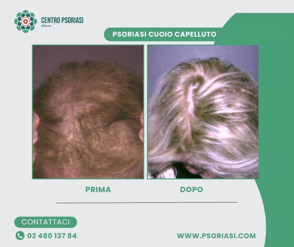 psoriasi cuoio capelluto