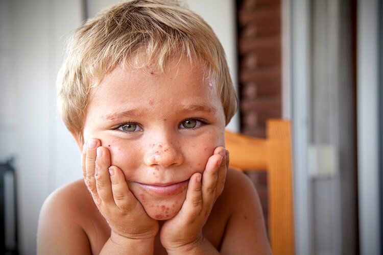 psoriasi bambini piccoli