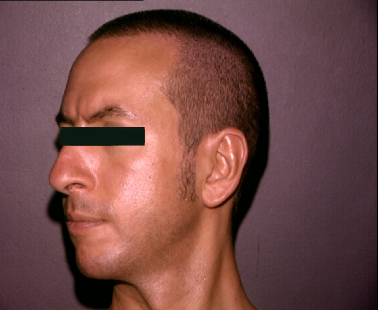 prima e dopo psoriasi uomo dopo guancia