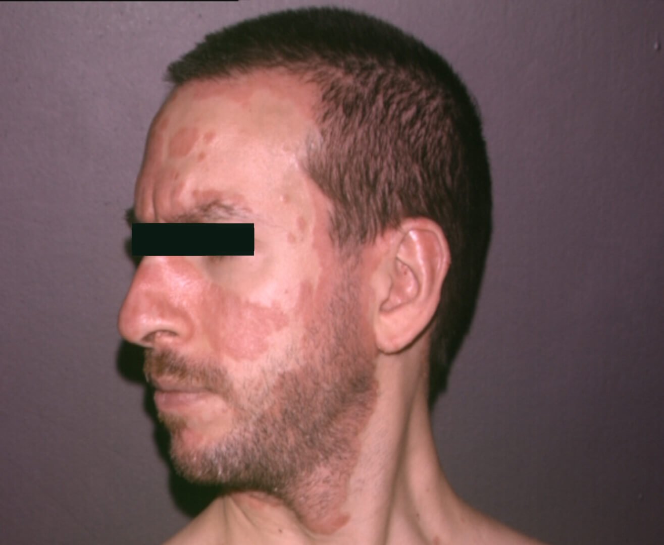 prima e dopo psoriasi uomo guancia