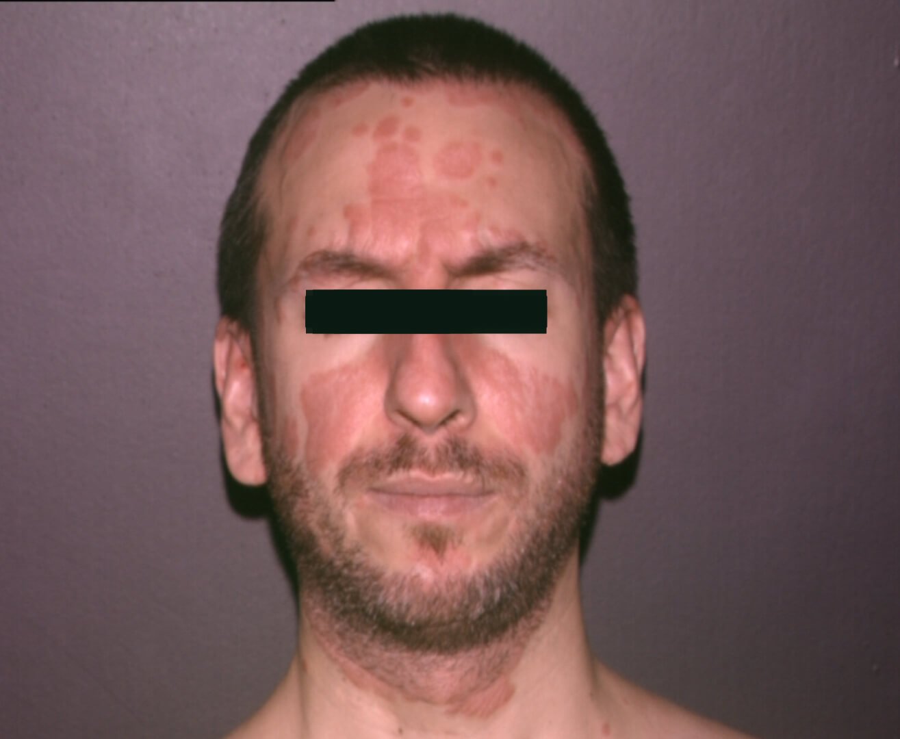 prima e dopo psoriasi uomo