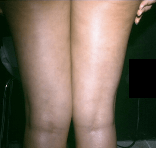 Psoriasi gambe dopo