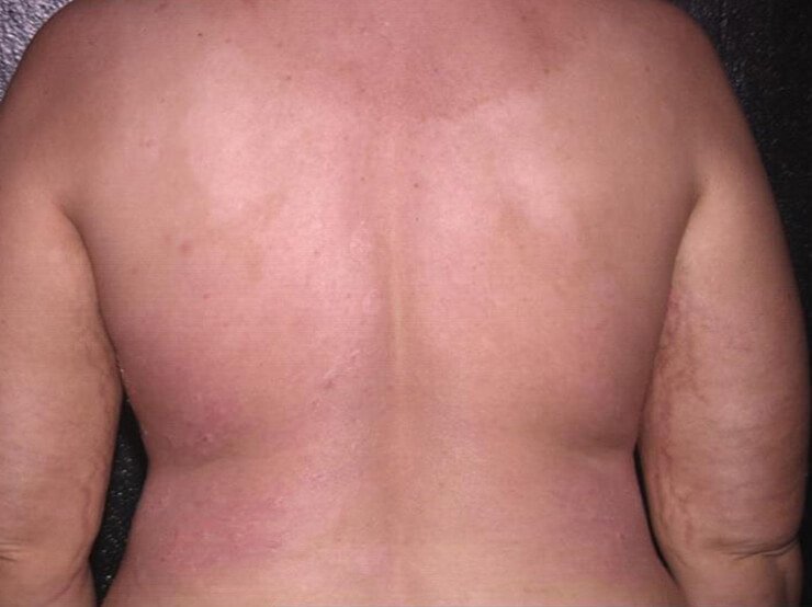 psoriasi-schiena-dopo.jpg