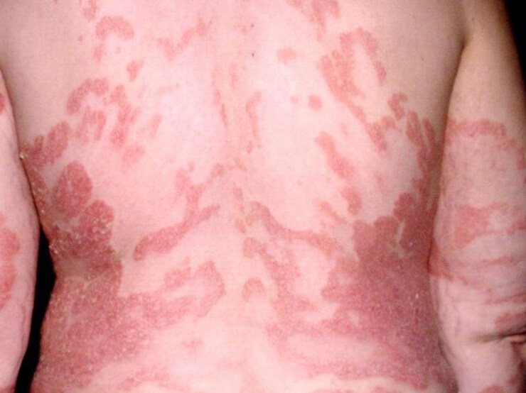 psoriasi-schiena-prima.jpg