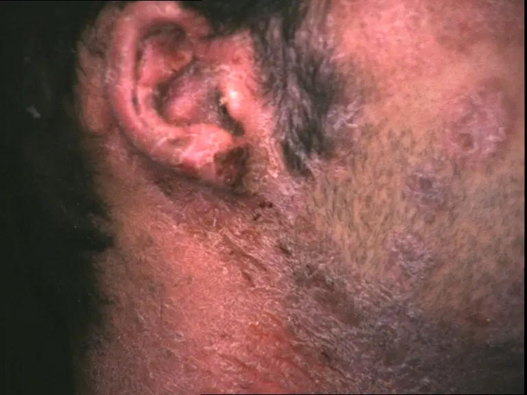 psoriasi orecchio