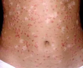 psoriasi addome